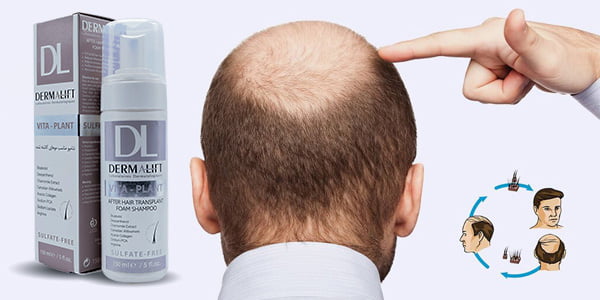 شامپو موهای کاشته شده درمالیفت